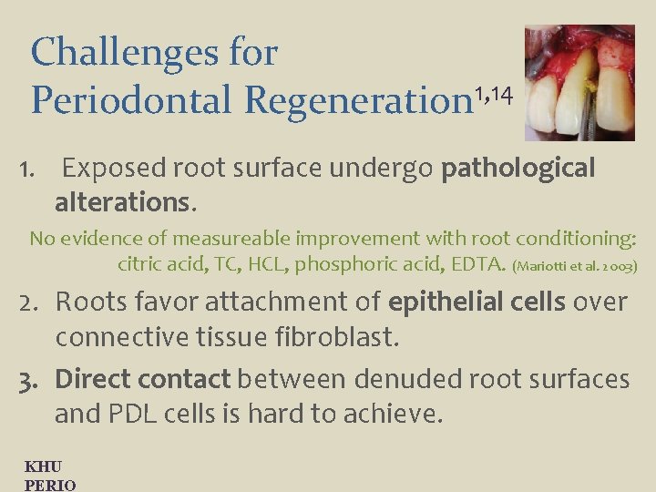 Challenges for Periodontal Regeneration 1, 14 1. Exposed root surface undergo pathological alterations. No