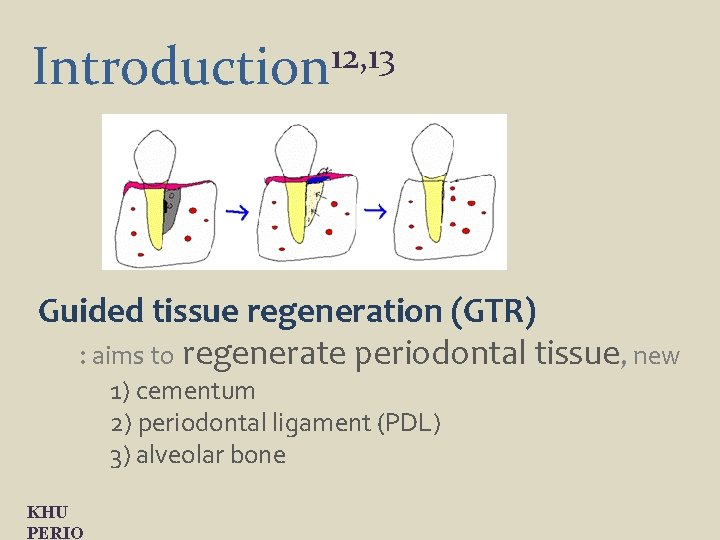 12, 13 Introduction Guided tissue regeneration (GTR) : aims to regenerate periodontal tissue, new