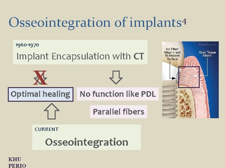 Osseointegration of implants 4 1960 -1970 Implant Encapsulation with CT X Optimal healing No