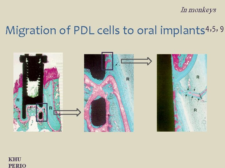 In monkeys Migration of PDL cells to oral implants 4, 5, 9 KHU PERIO