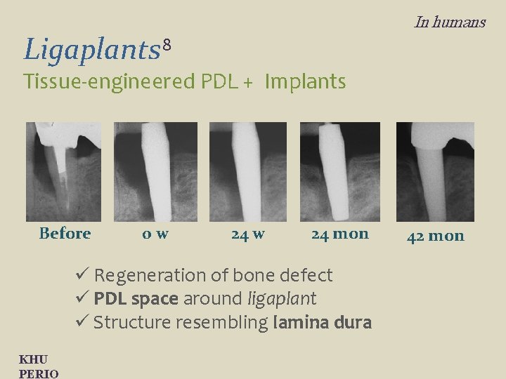 In humans Ligaplants 8 Tissue-engineered PDL + Implants Before 0 w 24 mon ü