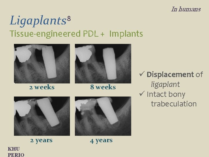 In humans Ligaplants 8 Tissue-engineered PDL + Implants KHU PERIO 2 weeks 8 weeks
