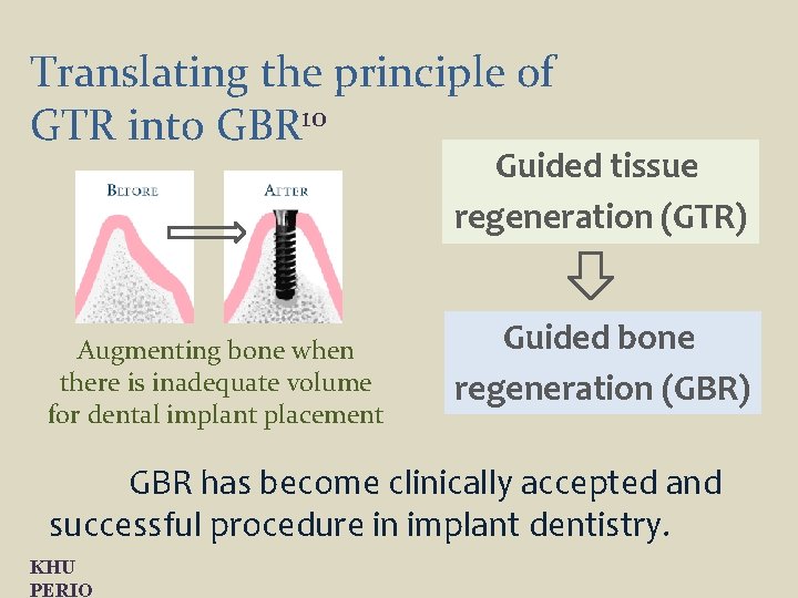 Translating the principle of GTR into GBR 10 Guided tissue regeneration (GTR) Augmenting bone