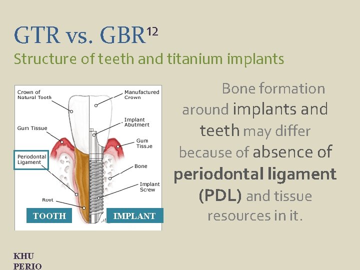 GTR vs. 12 GBR Structure of teeth and titanium implants Bone formation around implants