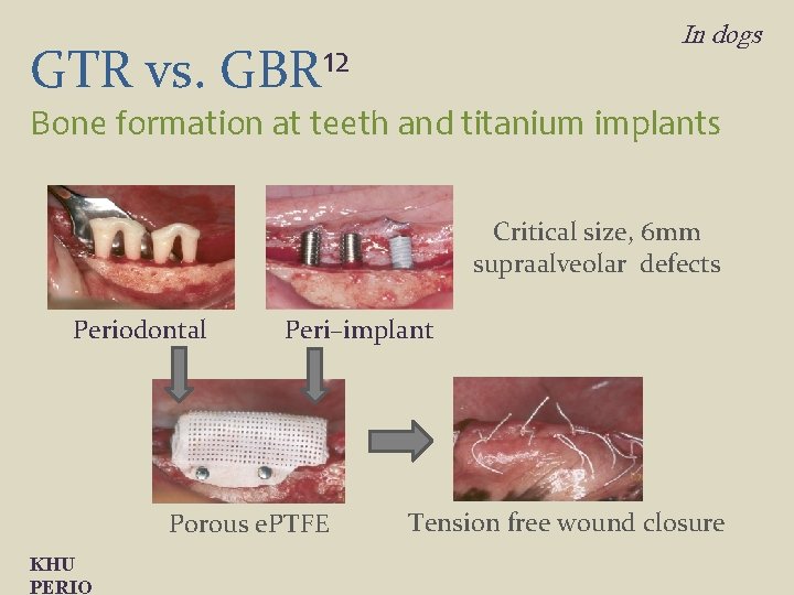 In dogs GTR vs. GBR 12 Bone formation at teeth and titanium implants Critical