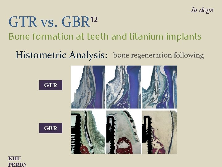 GTR vs. 12 GBR In dogs Bone formation at teeth and titanium implants Histometric