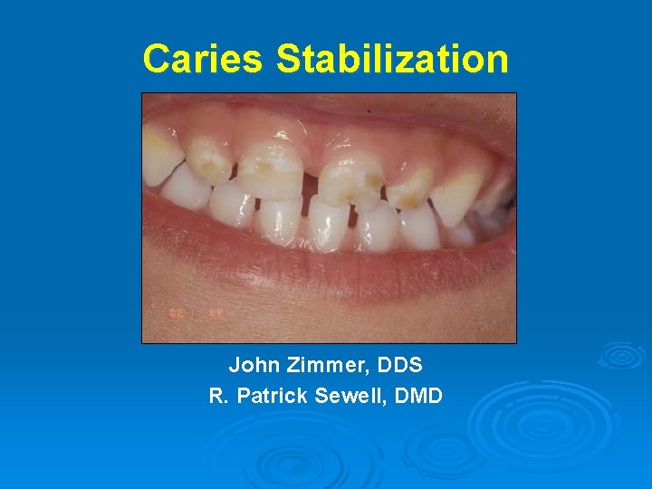 Caries Stabilization John Zimmer, DDS R. Patrick Sewell, DMD 