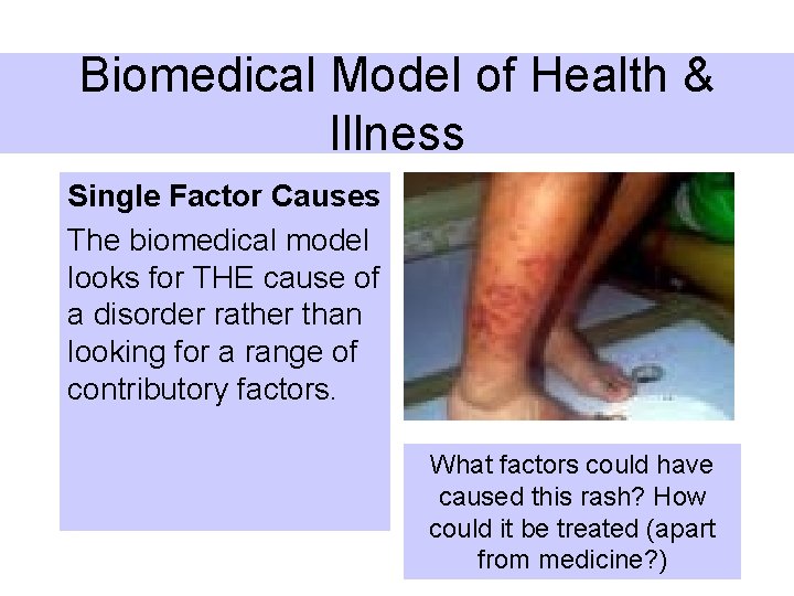 Biomedical Model of Health & Illness Single Factor Causes The biomedical model looks for