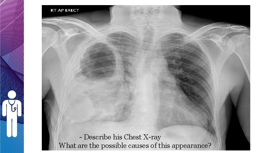 - Describe his Chest X-ray What are the possible causes of this appearance? - Describe his Chest X-ray What are the possible causes of this appearance?