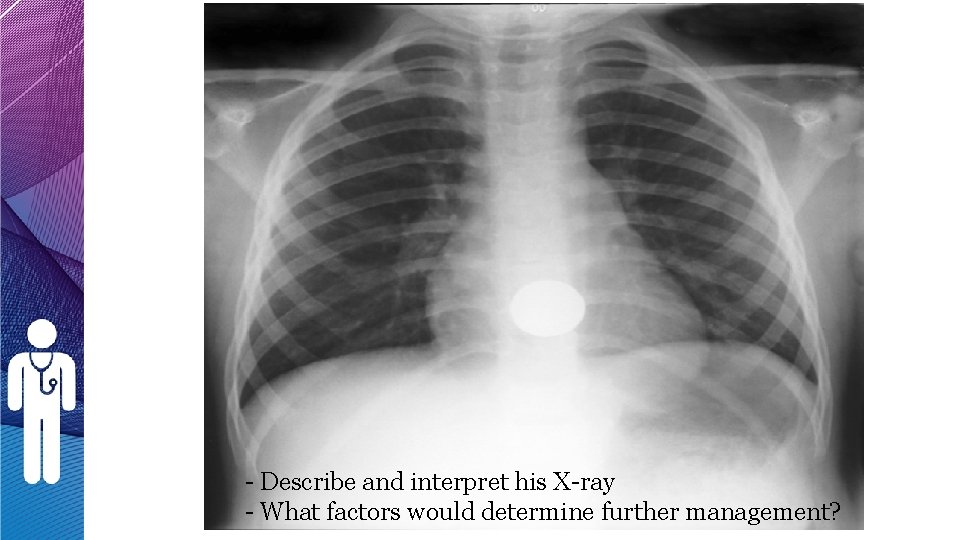 - Describe and interpret his X-ray - What factors would determine further management? - Describe and interpret his X-ray - What factors would determine further management?