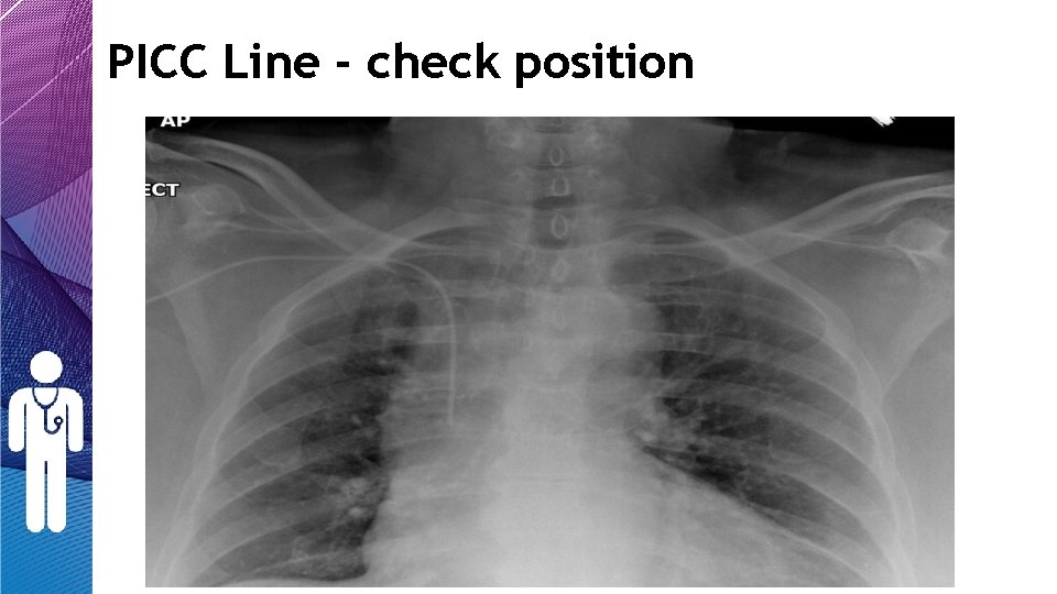 PICC Line - check position PICC Line - check position