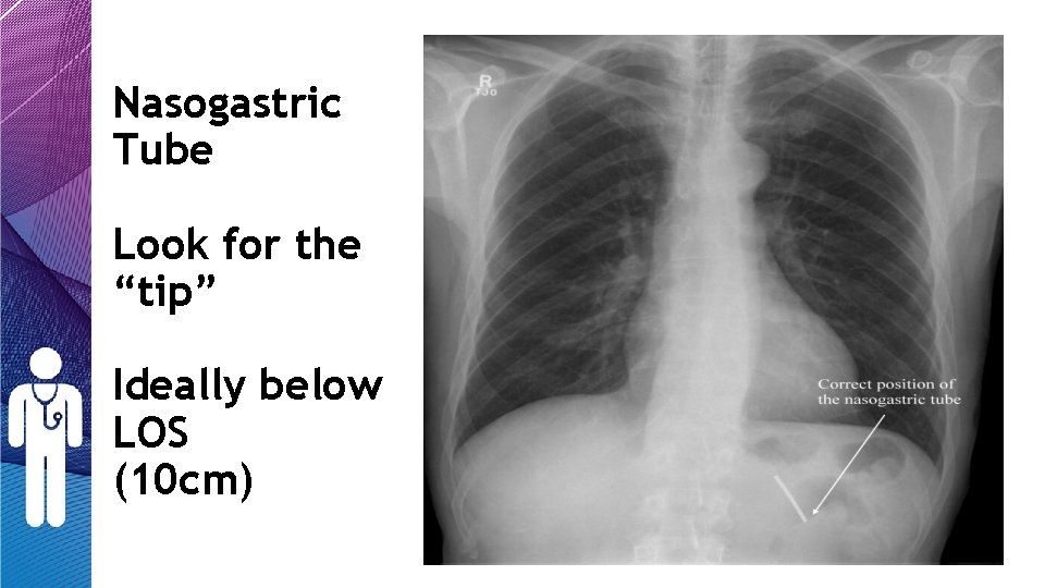 Nasogastric Tube Look for the “tip” Ideally below LOS (10 cm) Nasogastric Tube Look for the “tip” Ideally below LOS (10 cm)