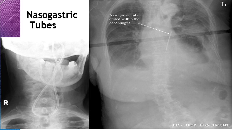 Nasogastric Tubes Nasogastric Tubes