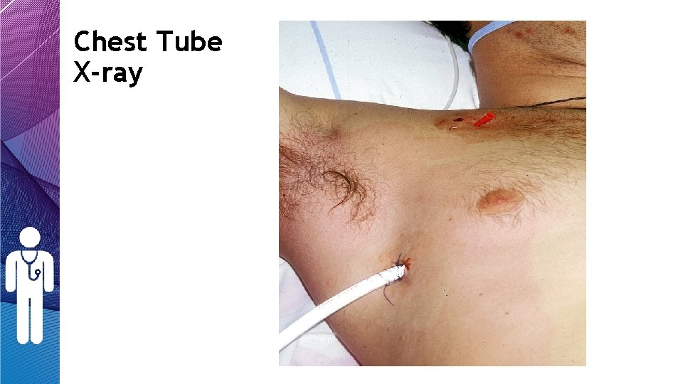 Chest Tube X-ray Chest Tube X-ray