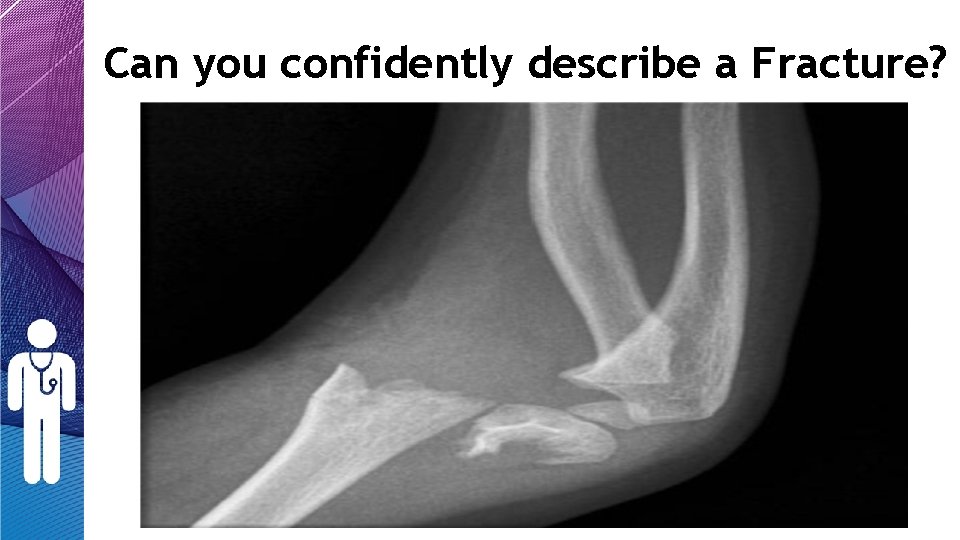 Can you confidently describe a Fracture? Can you confidently describe a Fracture?