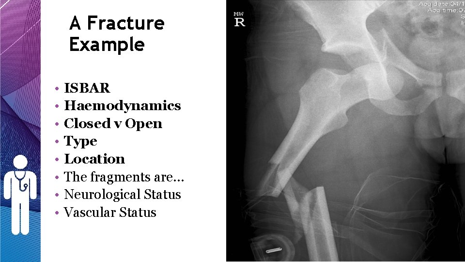 A Fracture Example • • ISBAR Haemodynamics Closed v Open Type Location The fragments A Fracture Example • • ISBAR Haemodynamics Closed v Open Type Location The fragments