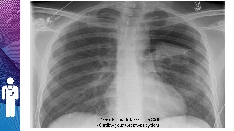 - Describe and interpret his CXR - Outline your treatment options - Describe and interpret his CXR - Outline your treatment options