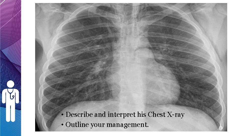 • Describe and interpret his Chest X-ray • Outline your management. • Describe and interpret his Chest X-ray • Outline your management.
