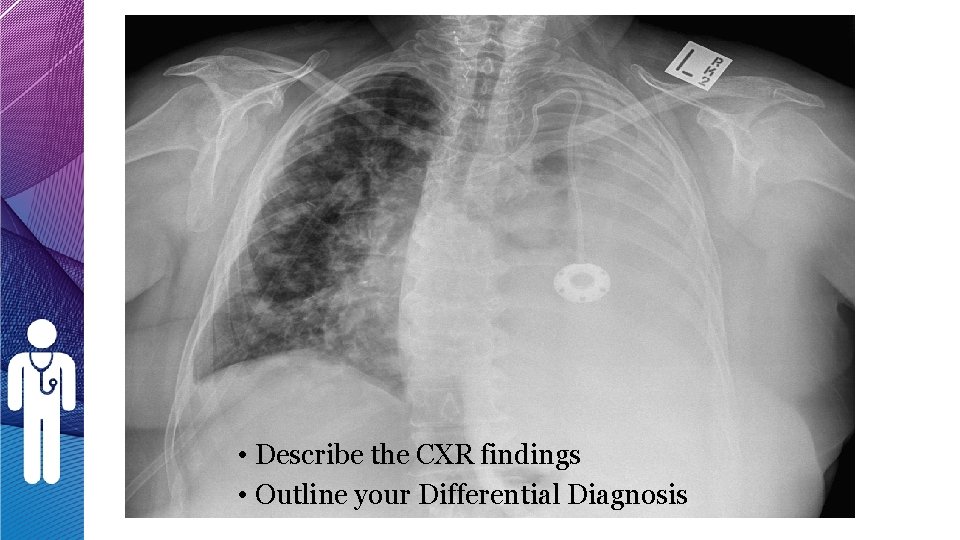 • Describe the CXR findings • Outline your Differential Diagnosis • Describe the CXR findings • Outline your Differential Diagnosis