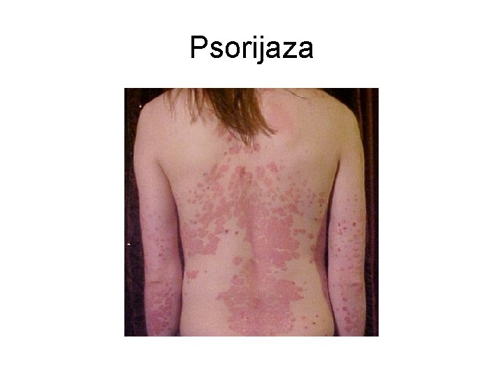 Psorijaza 