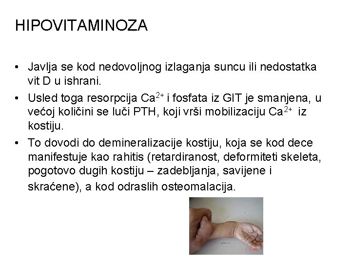 HIPOVITAMINOZA • Javlja se kod nedovoljnog izlaganja suncu ili nedostatka vit D u ishrani.