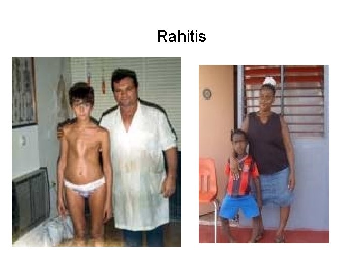 Rahitis 