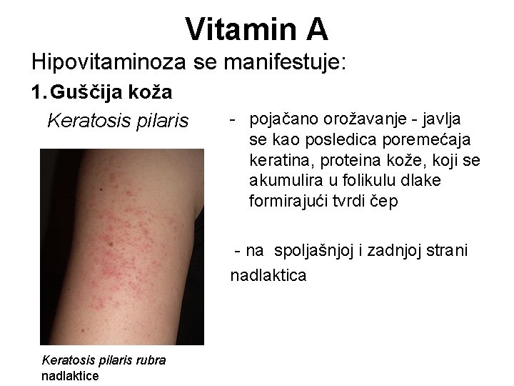 Vitamin A Hipovitaminoza se manifestuje: 1. Guščija koža Keratosis pilaris - pojačano orožavanje -