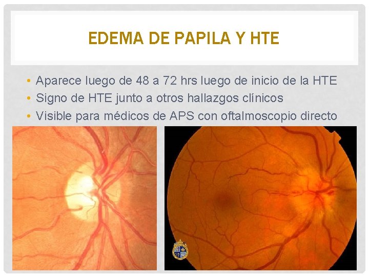 EDEMA DE PAPILA Y HTE • Aparece luego de 48 a 72 hrs luego