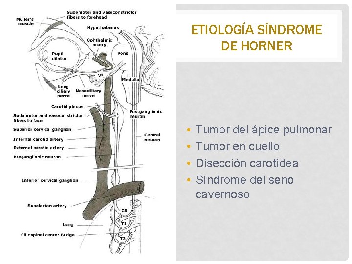 ETIOLOGÍA SÍNDROME DE HORNER • • Tumor del ápice pulmonar Tumor en cuello Disección