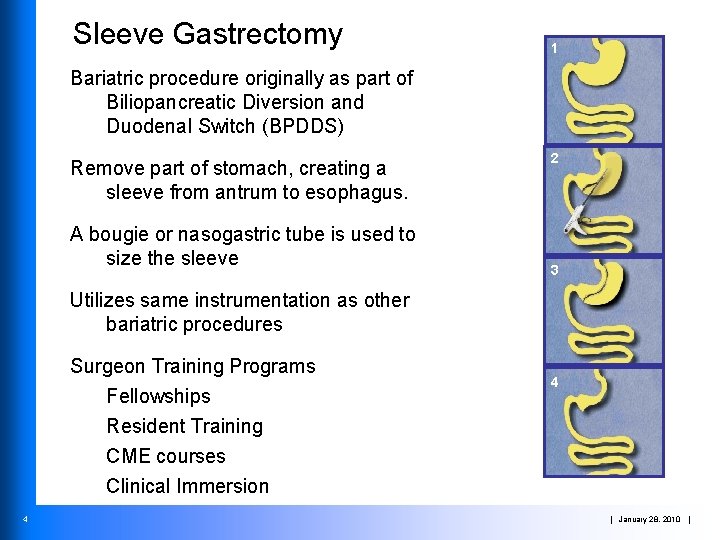 Sleeve Gastrectomy 1 Bariatric procedure originally as part of Biliopancreatic Diversion and Duodenal Switch