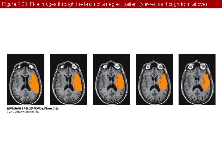 Figure 7. 23 Five images through the brain of a neglect patient (viewed as