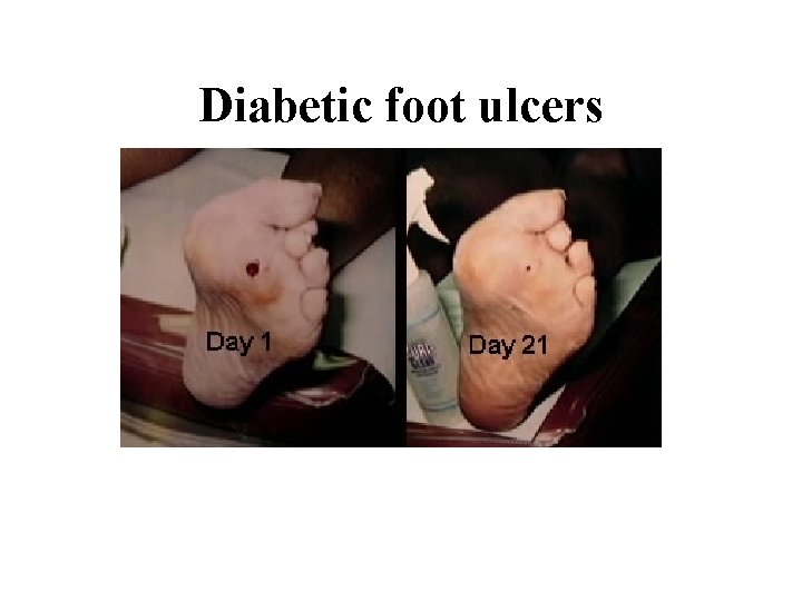 Diabetic foot ulcers 