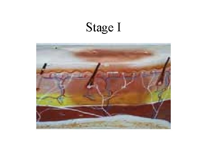 Stage I 