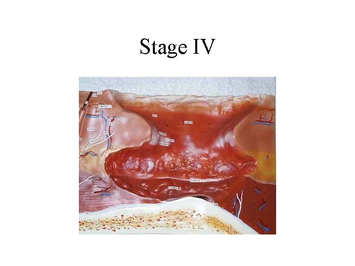 Stage IV 