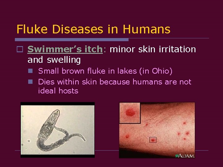 Fluke Diseases in Humans o Swimmer’s itch: minor skin irritation and swelling n Small Fluke Diseases in Humans o Swimmer’s itch: minor skin irritation and swelling n Small