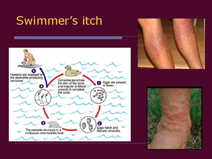 Swimmer’s itch Swimmer’s itch