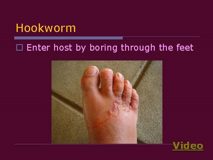 Hookworm o Enter host by boring through the feet Video Hookworm o Enter host by boring through the feet Video