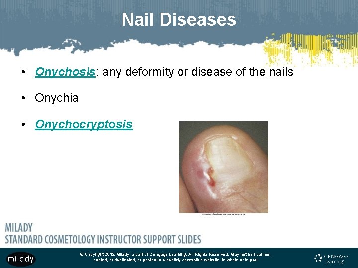 Nail Diseases • Onychosis: any deformity or disease of the nails • Onychia •