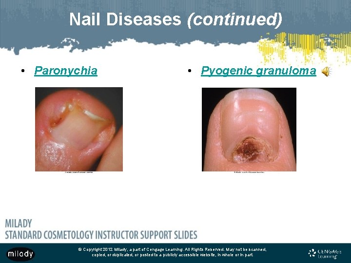 Nail Diseases (continued) • Paronychia • Pyogenic granuloma © Copyright 2012 Milady, a part