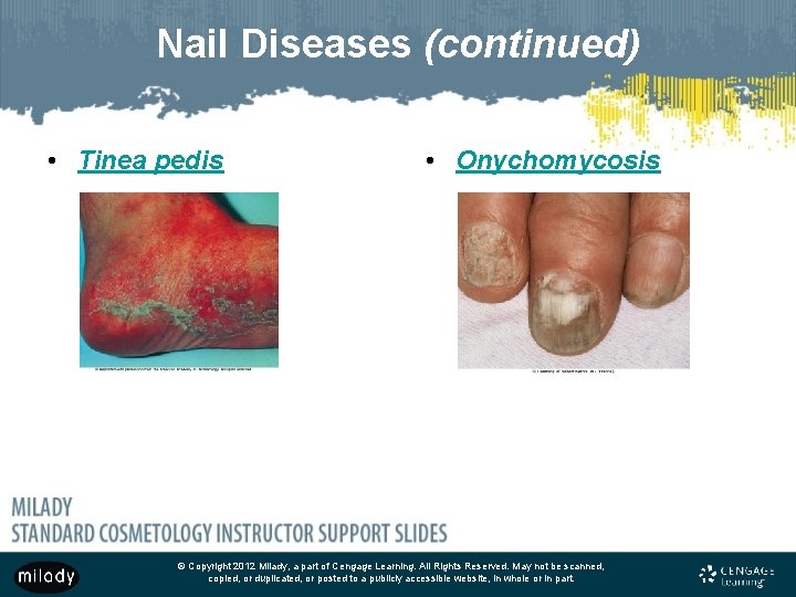 Nail Diseases (continued) • Tinea pedis • Onychomycosis © Copyright 2012 Milady, a part