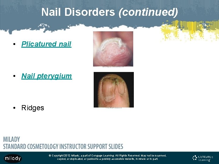 Nail Disorders (continued) • Plicatured nail • Nail pterygium • Ridges © Copyright 2012