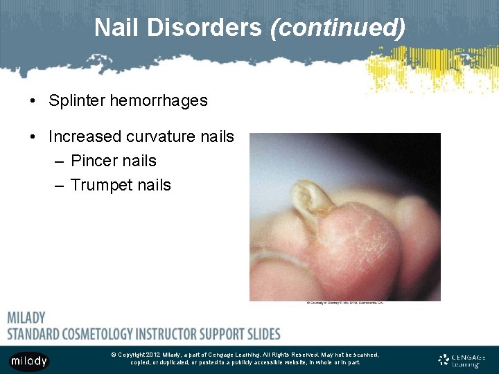 Nail Disorders (continued) • Splinter hemorrhages • Increased curvature nails – Pincer nails –