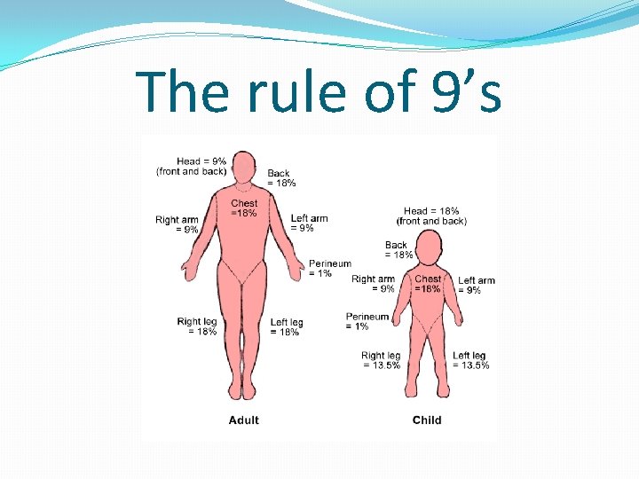The rule of 9’s 
