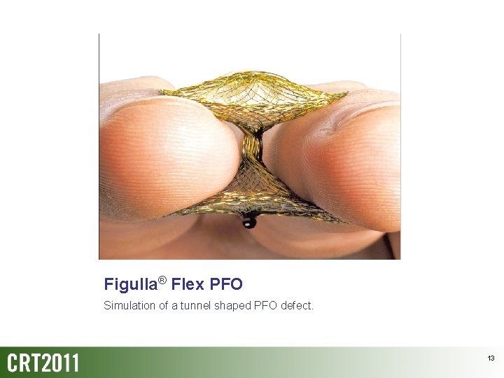 Figulla® Flex PFO Simulation of a tunnel shaped PFO defect. 13 