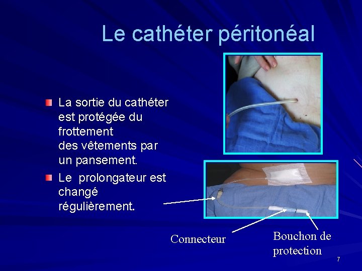 Le cathéter péritonéal La sortie du cathéter est protégée du frottement des vêtements par