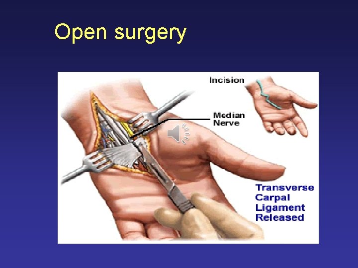 Open surgery 