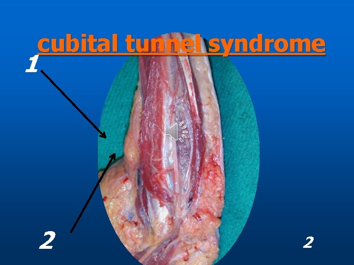 cubital tunnel syndrome 1 2 2 