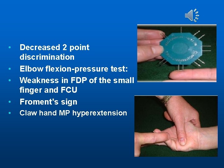  • Decreased 2 point discrimination Elbow flexion-pressure test: Weakness in FDP of the