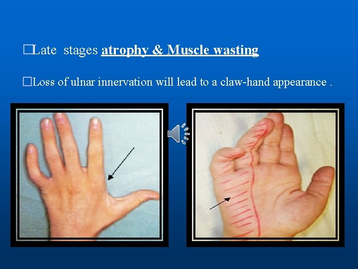 �Late stages atrophy & Muscle wasting �Loss of ulnar innervation will lead to a