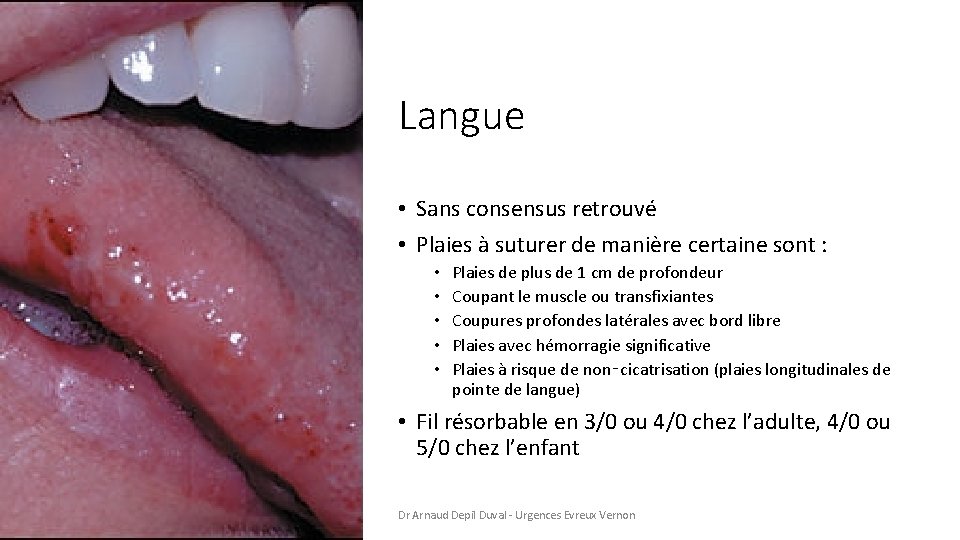 Langue • Sans consensus retrouvé • Plaies à suturer de manière certaine sont :